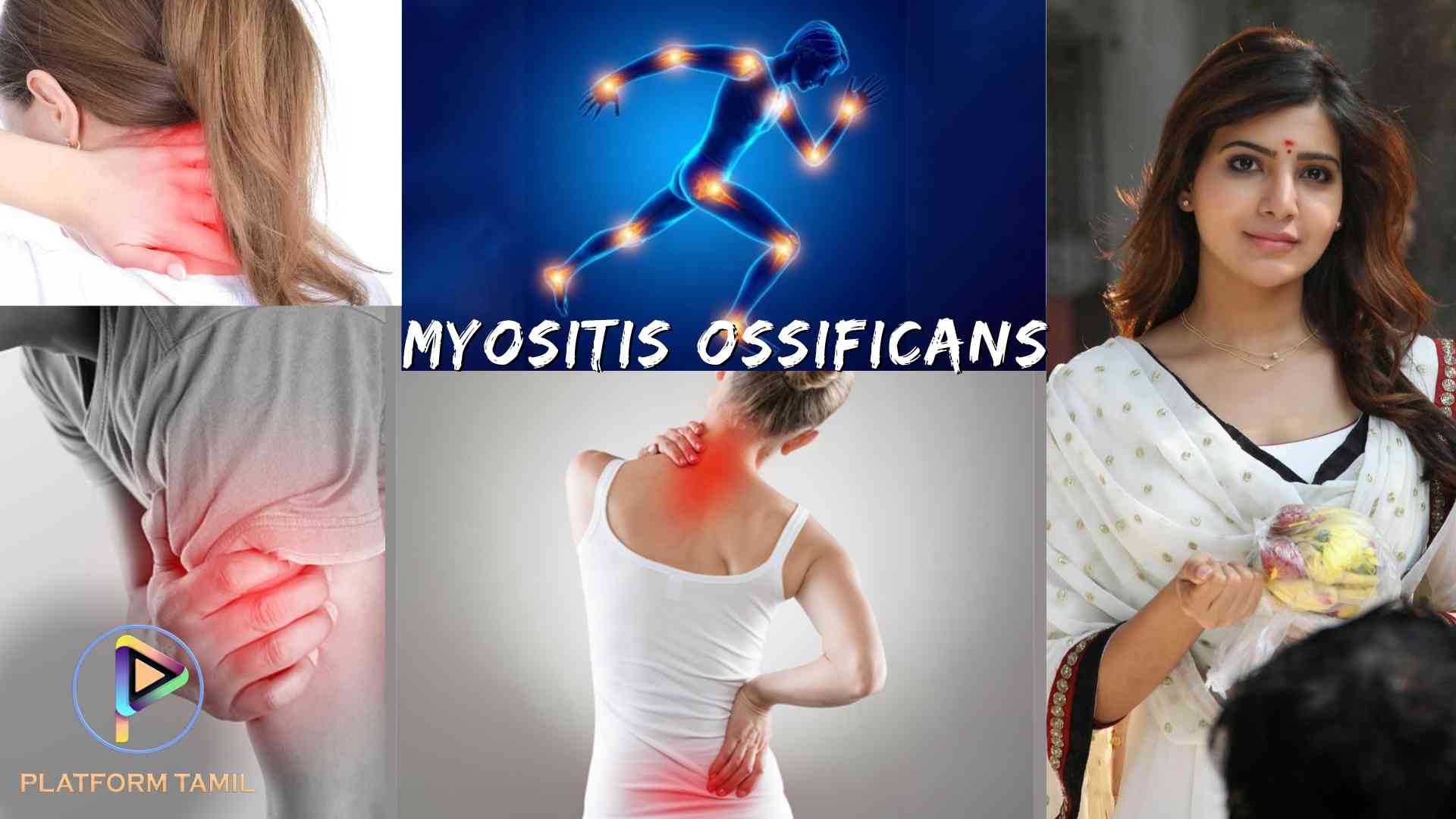 Myositis Symptoms and Types - Platform Tamil